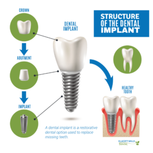 EMD-Dental-Implant-Graphic